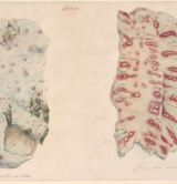 7-Wellcome-Collection-Watercolour-Drawing-Of-Two-Portions-Of-The-Intestines,-Illustrating-The-Morbid-Effects-Of-A-Case-Of-Dysentery-With-Typhoid-Fever